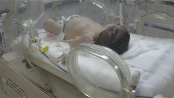 مستشفى أسيوط عن طفلة تحمل جنين غير مكتمل: 'تحدث بنسبة واحد في مليون'