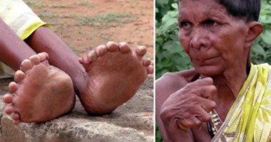 مسنة هندية تدخل موسوعة جينيس بـ31 إصبعا فى يديها وقدميها.. صور
