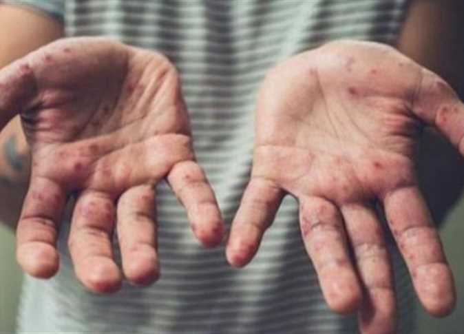 «المصل واللقاح» توجه رسالة طمأنة للمواطنين بشأن «جدري القرود»