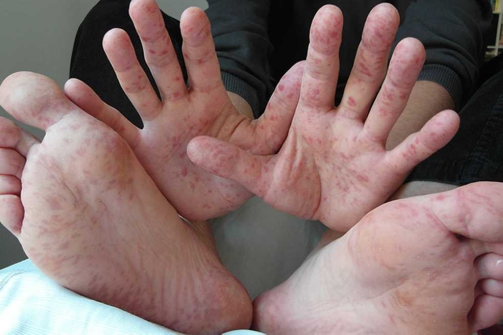 فيروس (HFMD).. حقيقة إصابات الطلاب وشائعة غلق مدرسة دولية